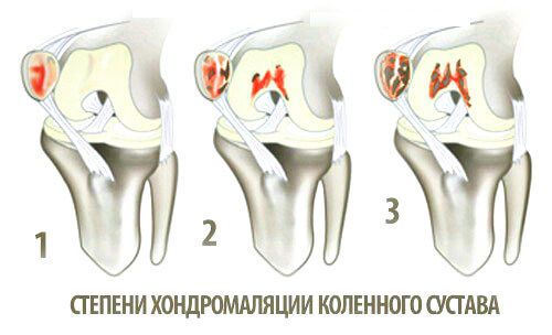 Какво представлява хондромалацията на колянната става