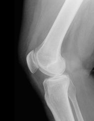 Какво представлява лигаментът на колянната става?