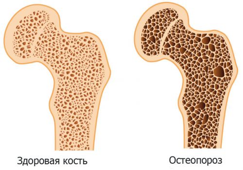 Какво представлява остеодистрофията