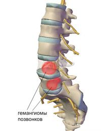 Хемангиом на различни части на гръбнака и неговото лечение