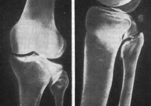Фрактура на коляното