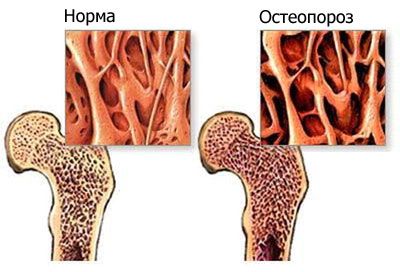 Остеопороза на тазобедрената става и нейното лечение