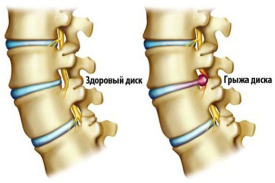 Полисегментарна остеохондроза на гръбнака