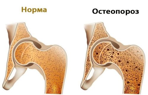 Постменопаузална остеопороза