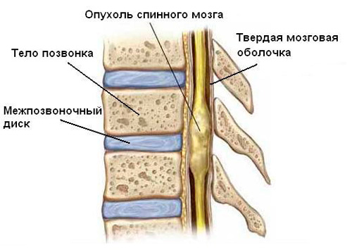 Тумори на гръбначния стълб