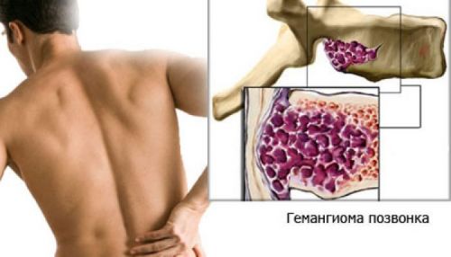 Какво е гръбначния хемангиролом