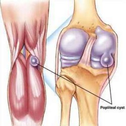 Kid Baker Knee Joint: Симптоми и лечение