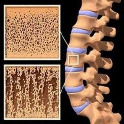 Симптоми на остеопорозата: какво е важно да се запомни пациентът