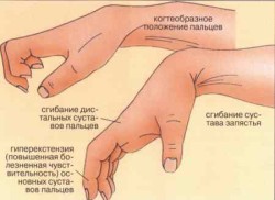 Контракти на ставите на ръката (контрактура на Dupuytren): симптоми и лечение