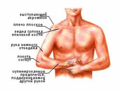 Дислокация на рамото: причини, симптоми и лечение