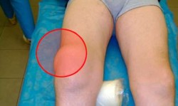 Епикондилит на коляното: причини за появата, симптомите, лечението