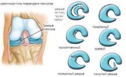 Увреждане на менискуса на колянната става: симптоми и лечение