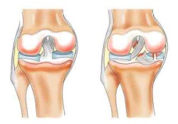 Увреждане на менискуса на колянната става: симптоми и лечение