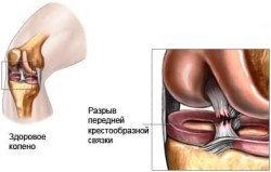 Разрушаване на сухожилията на колянната става: причини, симптоми и лечение