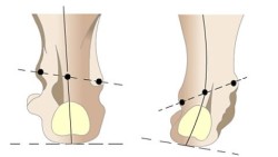 Валгус деформация на краката при деца: какво е това, симптоми, лечение