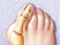Конуси по краката: причини за появата, симптомите и методите на лечение