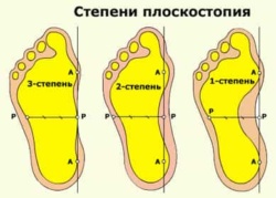 Плоски крака при възрастни и деца: степени, симптоми, методи на лечение