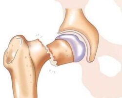 Фрактура на шийката на бедрената кост: причини, симптоми, усложнения и методи на лечение