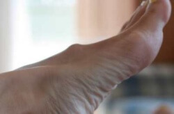 Хигрома на крака: какви са причините, симптомите и лечението