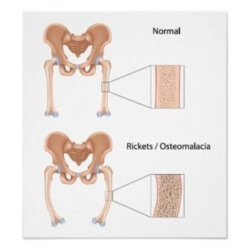 Остеомалация: причини, симптоми и лечение на заболяването