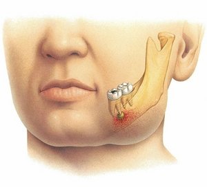 Остеомиелит на челюстта: видове, симптоми и методи за лечение на това заболяване