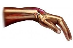 Навяхване на ръцете: симптоми, първа помощ и методи на лечение