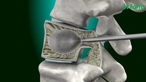 Компресионна фрактура на гръбначния стълб при възрастните: защо се проявява, как се проявява и се лекува