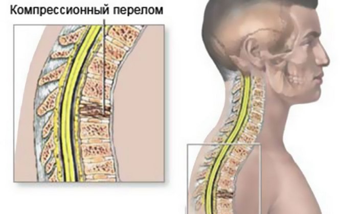 Компресионна фрактура на гръдния кош: причини, признаци и методи за лечение на такава травма