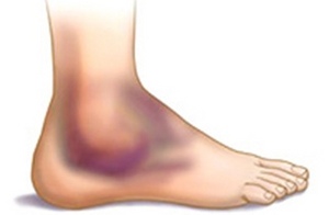 Изместване на краката: причини, симптоми, първа помощ и лечение