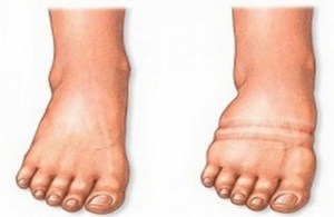 Едем на краката при възрастните хора: причините и методите на лечение
