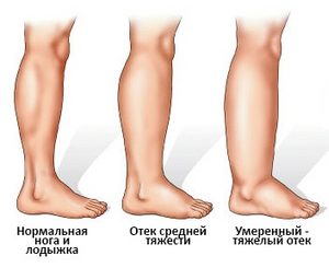 Едем на краката при възрастните хора: причините и методите на лечение