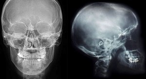 Фрактура на основата на черепа: симптоми и видове на такава травма, нейното лечение