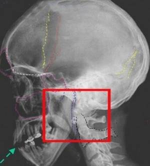 Фрактура на основата на черепа: симптоми и видове на такава травма, нейното лечение