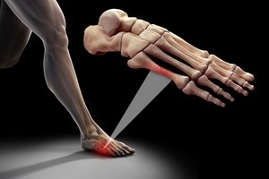 Фрактури на метатарзалната кост на крака: причини, симптоми, първа помощ и лечение