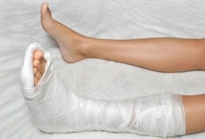 Фрактури на метатарзалната кост на крака: причини, симптоми, първа помощ и лечение
