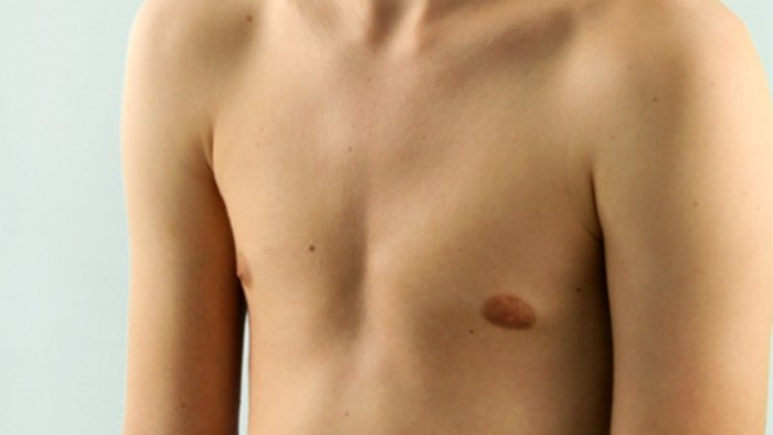 Деформация на гръдния кош във формата на фуния: причини, степени, симптоми и лечение на това заболяване