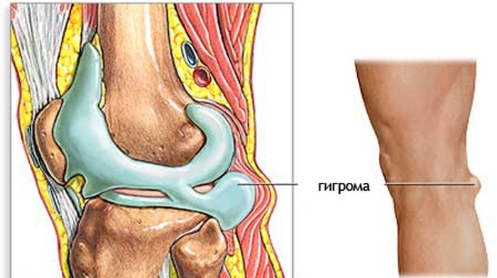 Хигрома на коляното: видове, причини, симптоми и лечение на такова заболяване