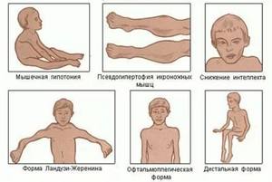 Миопатия: видовете, симптомите и методите за лечение на това заболяване