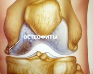 Остеофити на колянната става: как и кога се образуват симптомите и методите на лечение