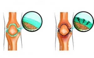 Болка в коленете, когато клекнат и ставате: лечение на заболявания, които причиняват дискомфорт