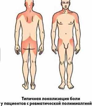 Ревматична полимиалгия: как се проявява и се лекува