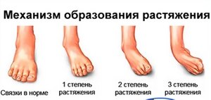Разтягане на краката на краката: характеристики на лечението, първа помощ