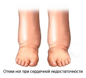Причини за оток на краката под коляното: какви са те