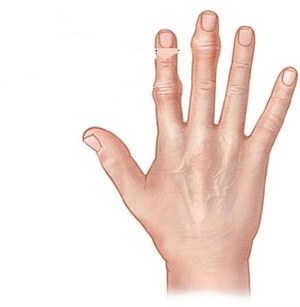Образуването на конуси върху пръстите: причините и лечението