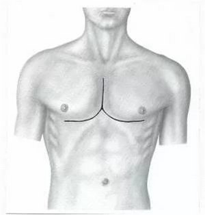 Kielid гърдите: причини, видове, симптоми и лечение на това заболяване