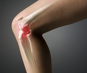 Краката боли зад коляното: причините за това състояние, диагнозата и лечението му