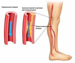 Краката боли от бедрото до крака: защо възниква подобно състояние и как да се премахне дискомфорта
