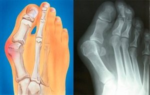 Кост (бум) на големия пръст: как се развива и какви методи за отстраняване