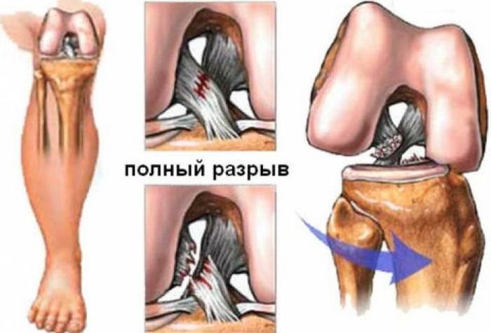 Прекъсвания на задния кръстоскиден сухожилие: причини, признаци и методи на лечение