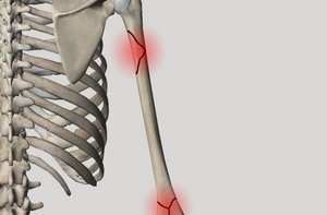 Фрактура на раменната кост: причини, видове и симптоми, първа помощ, лечение